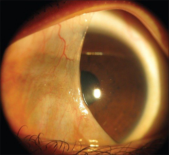 Close up of a human eye which has a third eyelid half closed across the eye, going from side to side rather than top to bottom as with our main eyelids 