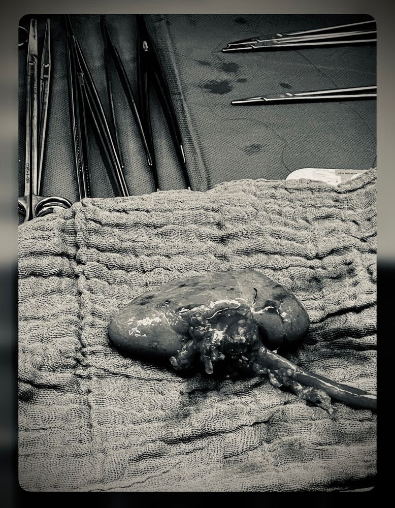 Meine kleine Niere, die ich jemandem gespendet habe , der sie dringend brauchte