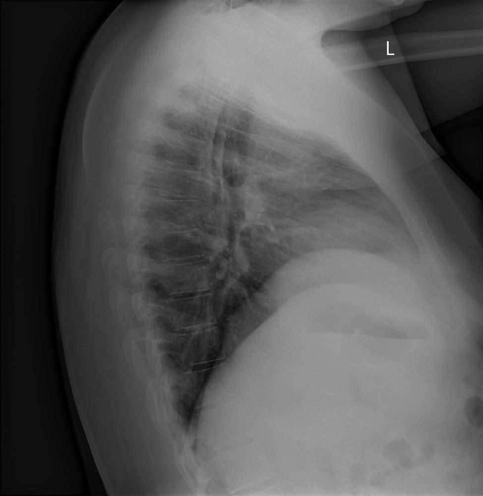 X-ray of my right side, arm raised with ribs, lungs visible 