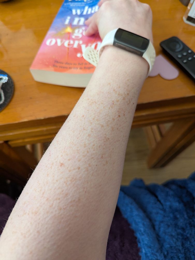 Close up of goosebumps on a pale arm