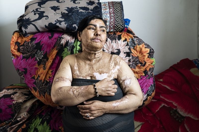 Un donna mostra parte del corpo deturpato dell'acido.