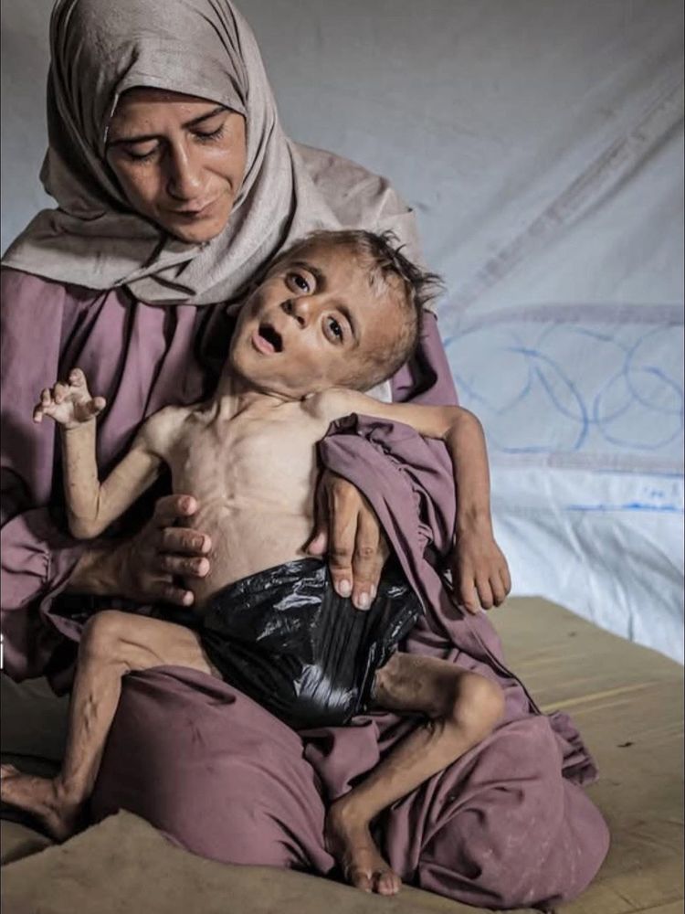 Muhammad Zakariya Ayyoub al-Matouq, a one-and-a-half-year-old child in Gaza City, Gaza, faces life-threatening malnutrition as the humanitarian situation worsens due to ongoing Israeli attacks and blockades. His mother cradles his almost lifeless body which is skeletal. A black, plastic bag is wrapped around him where a diaper would normally be. Photograph credit to Ahmed Jihad Ibrahim Al-arini for Anadolu via Getty Images