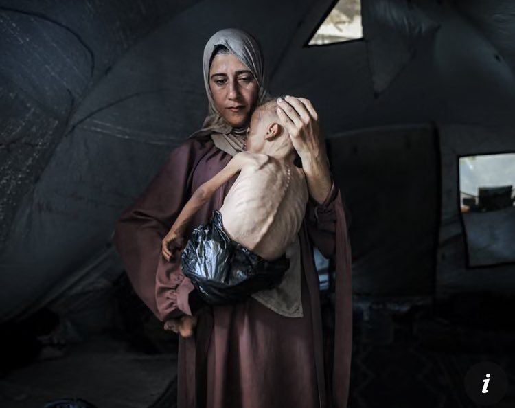 Muhammad Zakariya Ayyoub al-Matouq, a one-and-a-half-year-old child in Gaza City, Gaza, faces life-threatening malnutrition as the humanitarian situation worsens due to ongoing Israeli attacks and blockade. His mother cradles his almost lifeless body which is skeletal. Photograph credit to Ahmed Jihad Ibrahim Al-arini for Anadolu via Getty Images