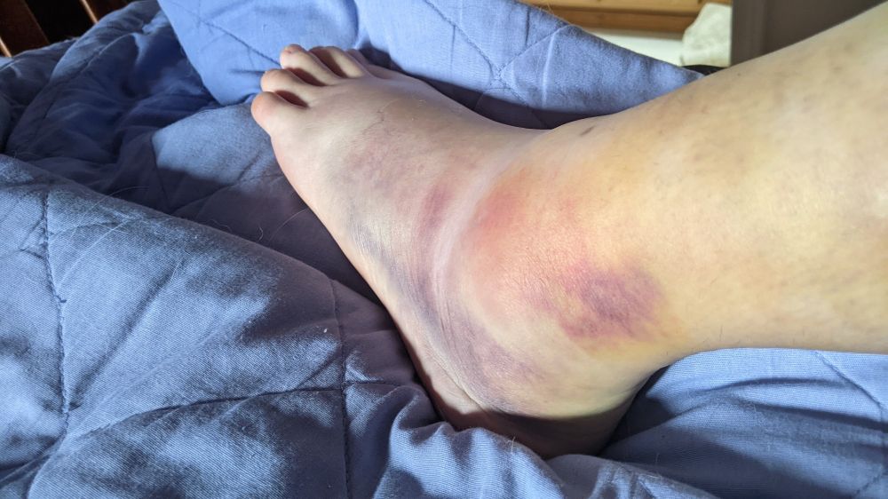 Jolene's swollen, bruised foot and ankle.