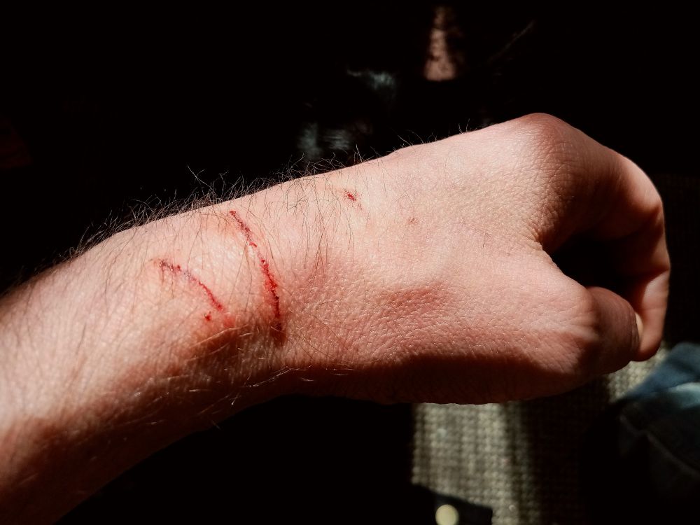 Pic shows a left hand with three minor scratches as a result of a wrestling match with a standard issue black cat that doesn't like cat carriers. 