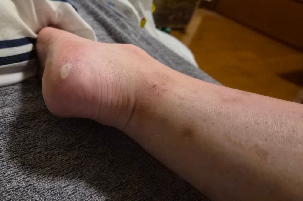 photo of the back/heel of my foot, there is a blister that is about 1/2 an inch wide on my heel. it is pale and full of fluid. yuck