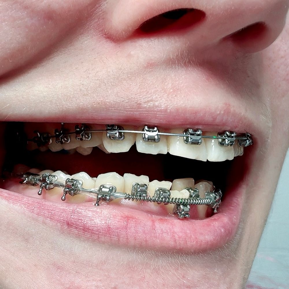 Відтягую на фото трохи щоку, щоб було видно що зараз на зубах