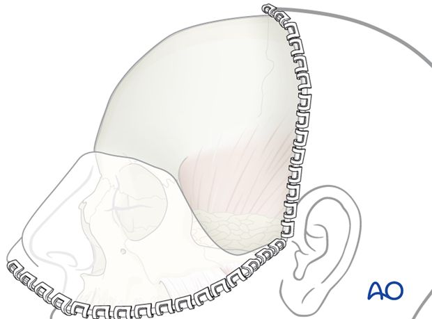 diagram depicting a coronal incision. The scalp is pulled over the face, revealing the underlying skull