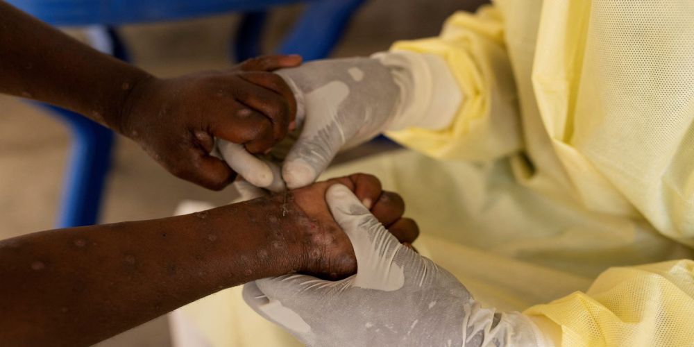 As mpox continues to cross borders, is the US prepared for an outbreak?