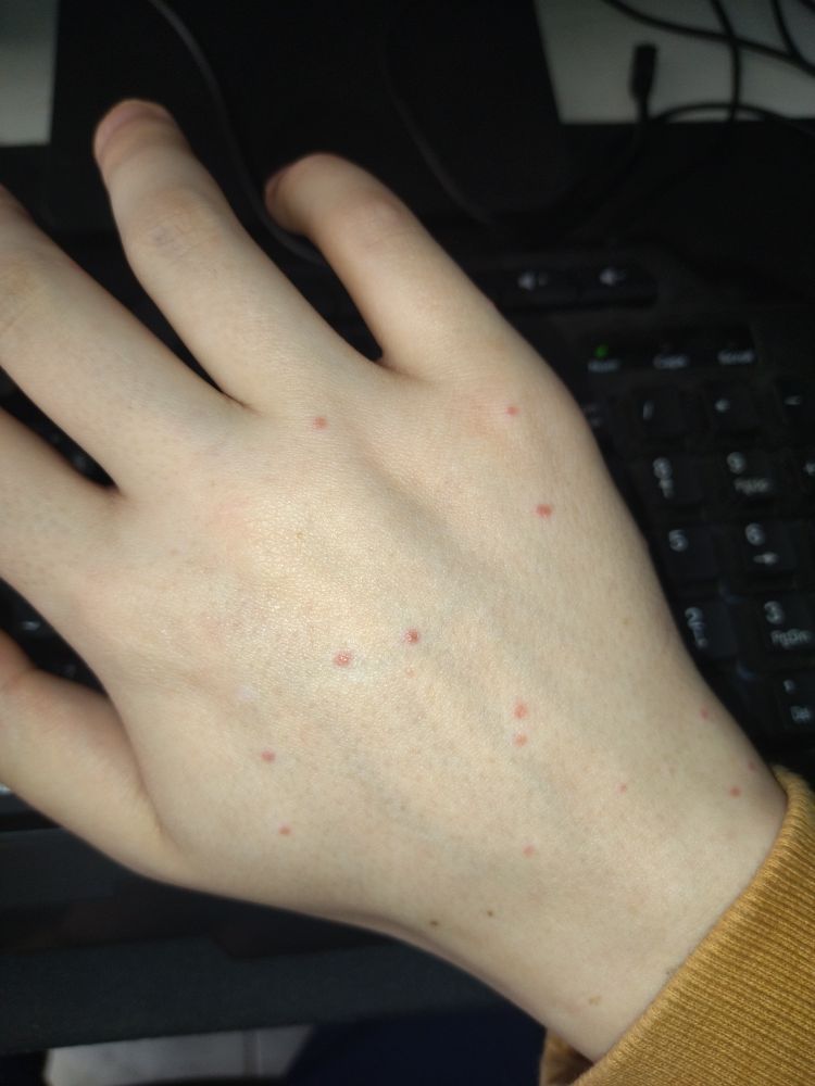 minha mão direita, cheia de marca de picada de muriçoca, ao fundo teclado preto.