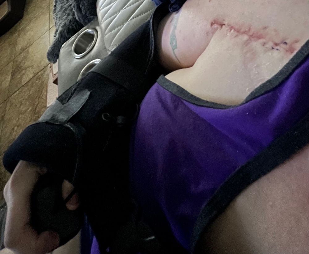 Picture of arm in sling & healing incision after shoulder replacement surgery 