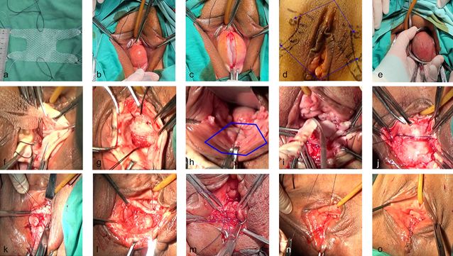 Physiological Reconstruction for Moderate–Severe Pelvic Organ Prolapse