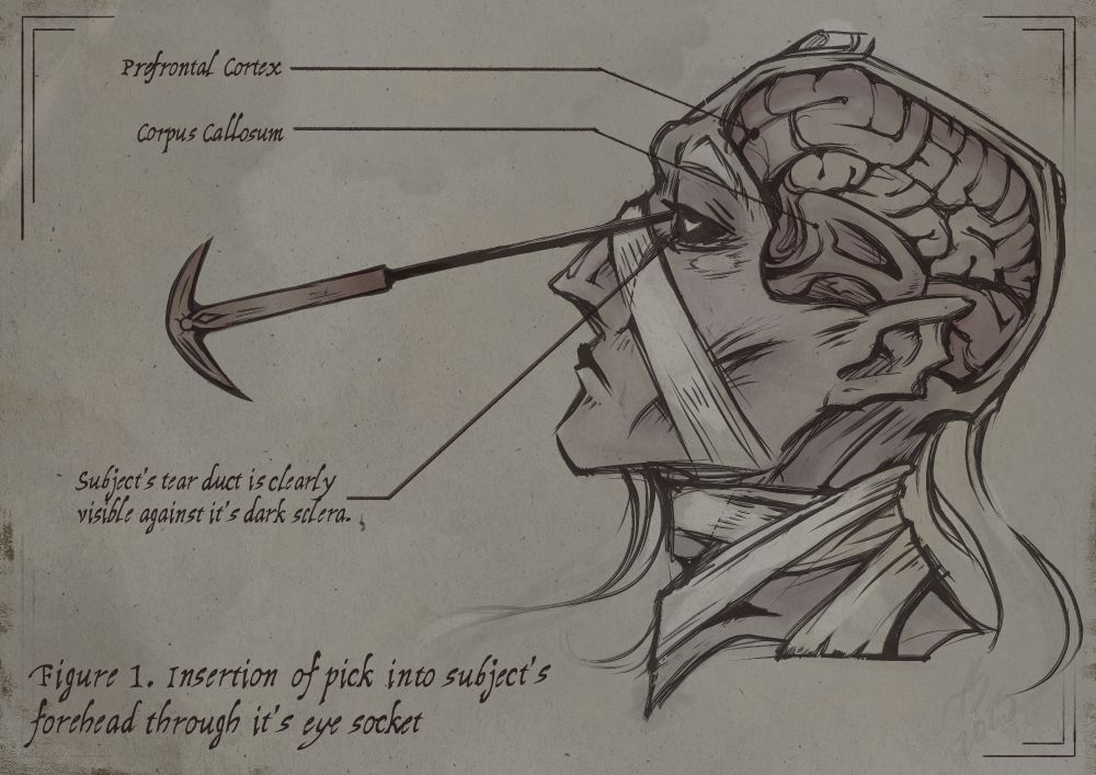 A digitally drawn fantastical medical drawing, depicting my OC, Devleik, receiving a lobotomy. He is a drow wrapped in bandages, with only a few thin strands of hair hanging over his shoulders, looking to the left side of the canvas. The right hemisphere of his brain is visible, with the prefrontal cortex and corpus callosum visible and labeled. Another label notes that his sclera, hidden behind the eyeball in this piece, is "clearly visible against it's [the subject's] dark sclera." The entire piece is labeled as "Figure 1. Insertion of pick into subject's forehead through it's eye socket." The colors of the piece are washed out, muted by the rough tan parchment texture.