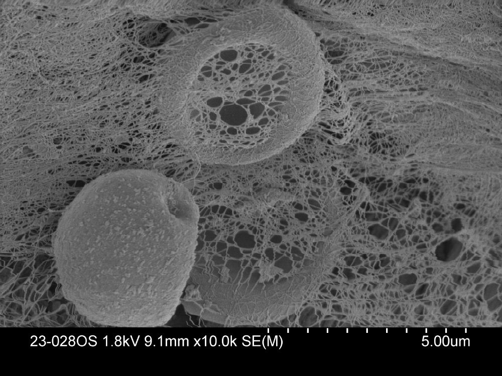 scanning EM of red blood cells with thin spiderweb-like covering due to maybe fibrin?