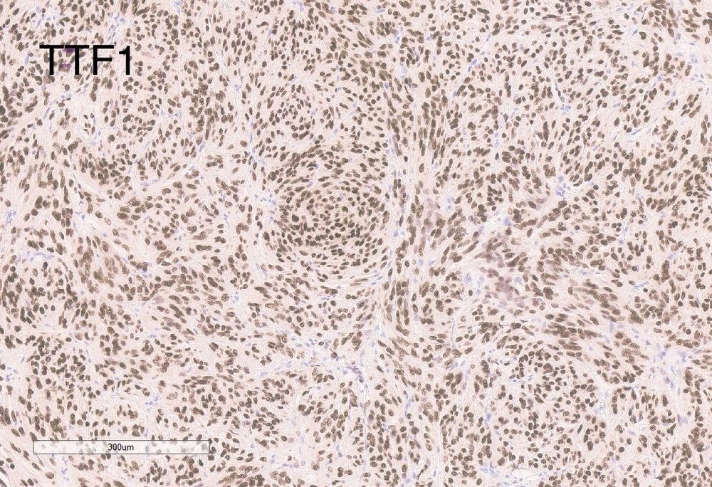 Nuclear staining for TTF1