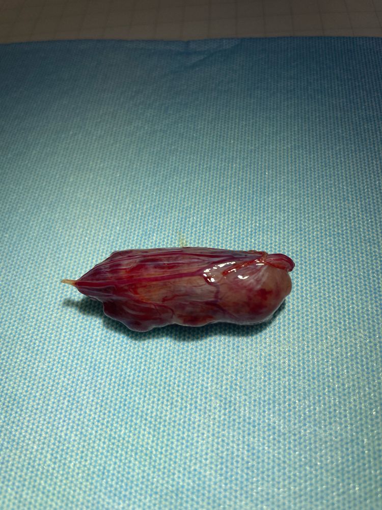 A sausage shaped tumor with attached filamentous band