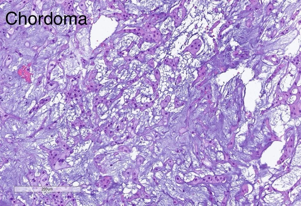 Permanent section of a chordoid highlighting the cords of tumor cells in a myxoid background 