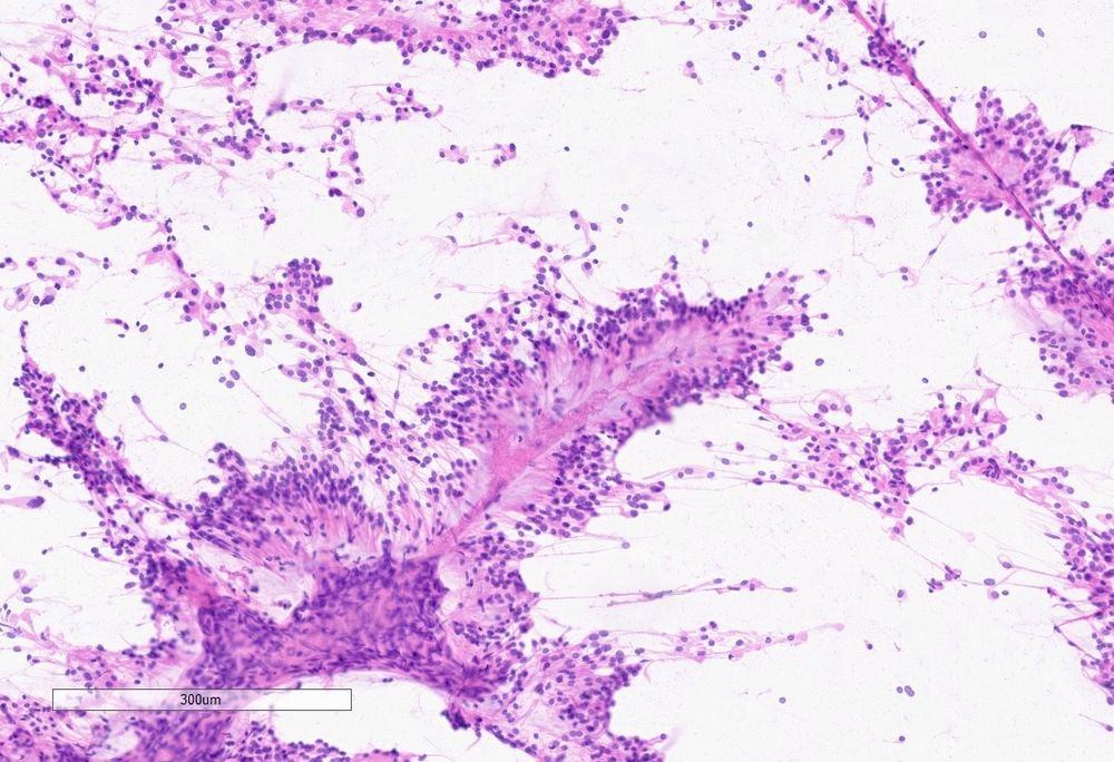 A squash preparation of a fibrillary neoplasm with myxoid background 