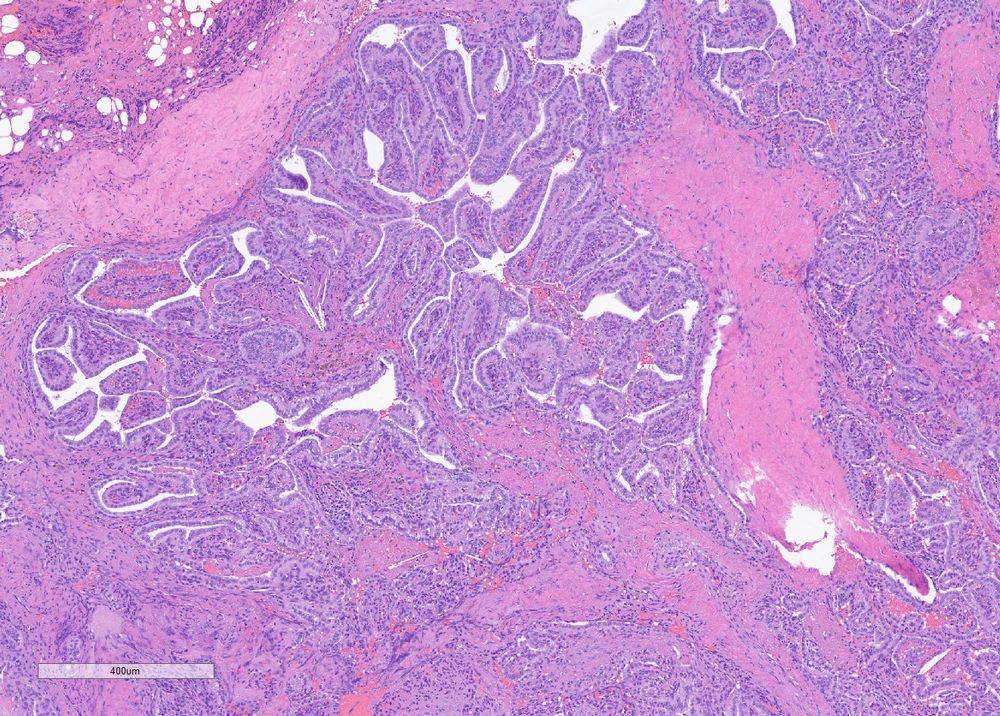 H&E stained section of a papillary neoplasm with bland cells arising within the ear 
