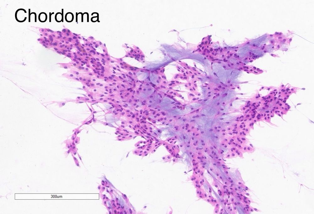 Smear preparation of a chordoma 