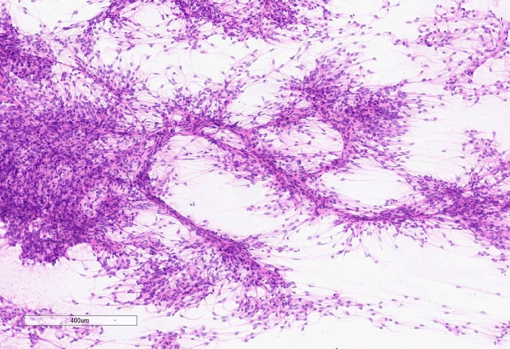 Smear preparation showing a fibrillary spindle cell neoplasm
