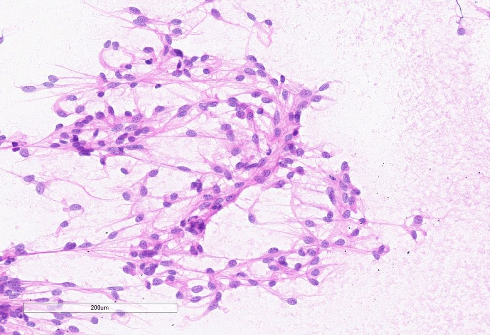 Close up of the prior smear showing fibrillary to feathery cytoplasm and ovoid nuclei 