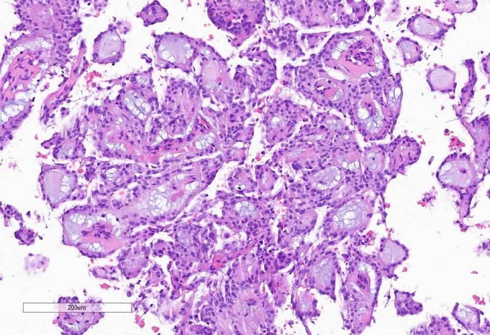 H&E stained section of papillae with myxoid cores 