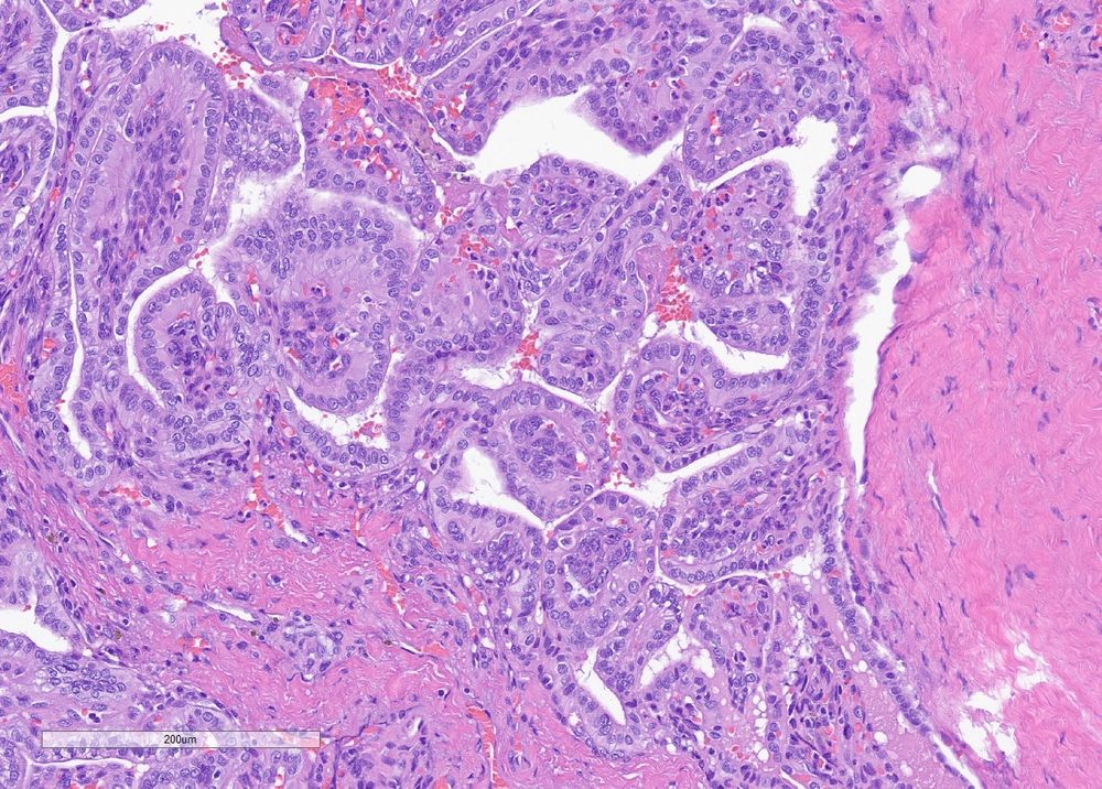 Higher power view of a papillary neoplasm stained with H&E 