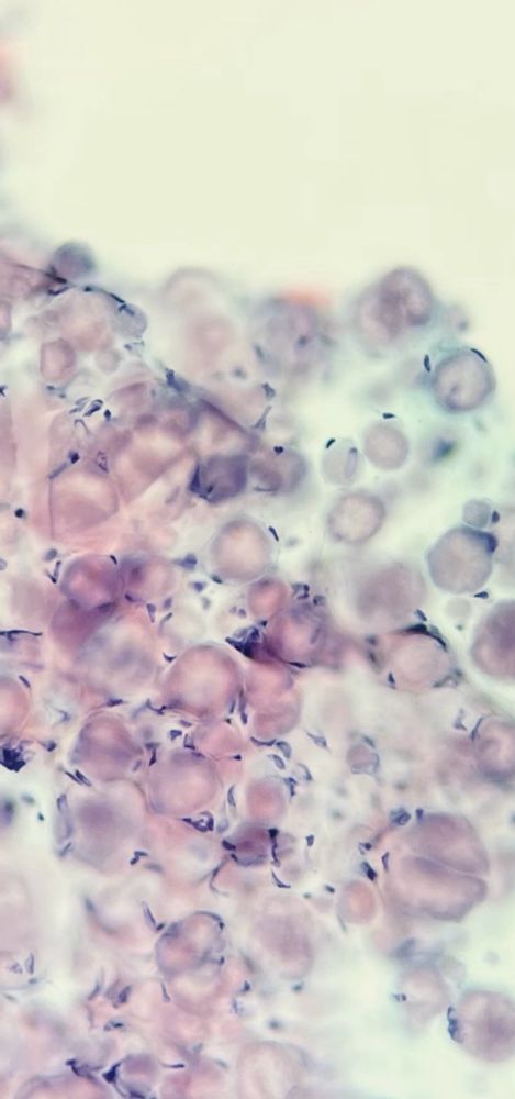 A cytology preparation showing pink amorphous blobs 