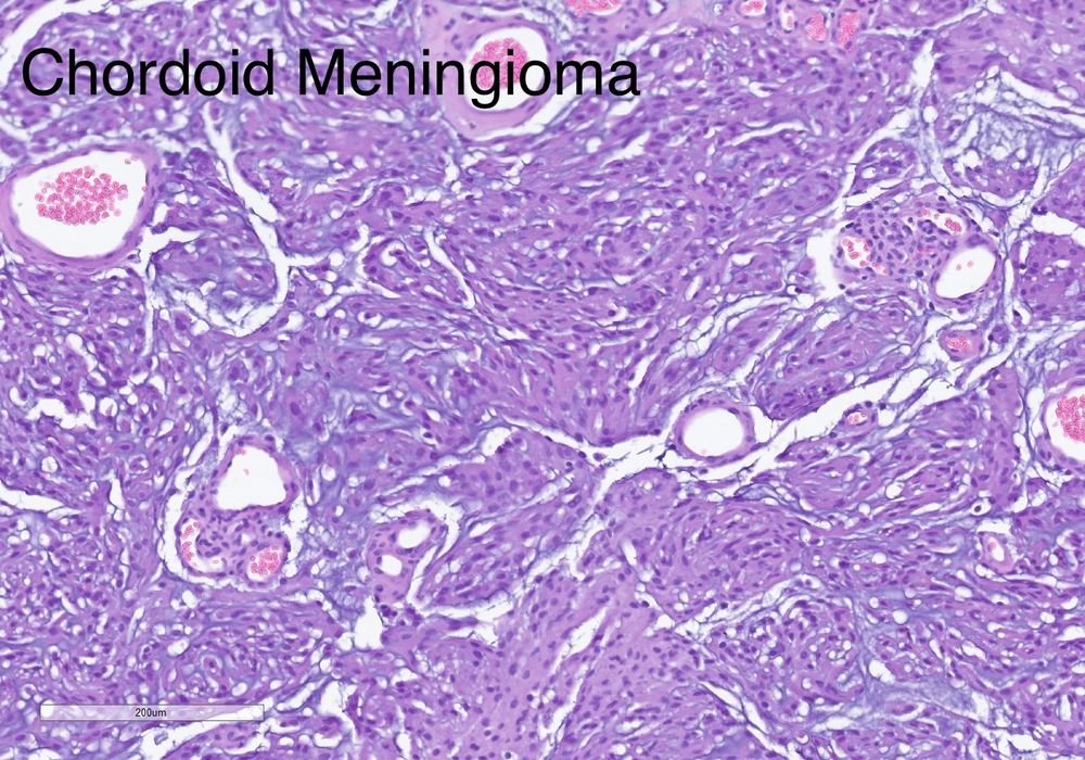 Permanent section of a chordoid meningioma showing focal whorl formation