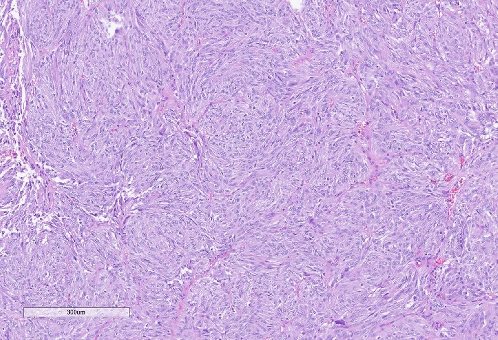 H&E stained permanent section showing a whorled to spindled bland appearing tumor