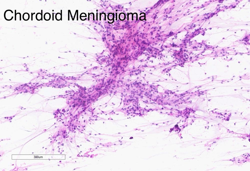 Smear preparation of a meningioma with chordoid features 