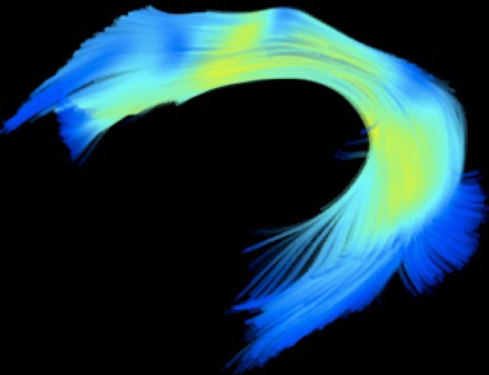 A diffusion image of the arcuate fasciculus