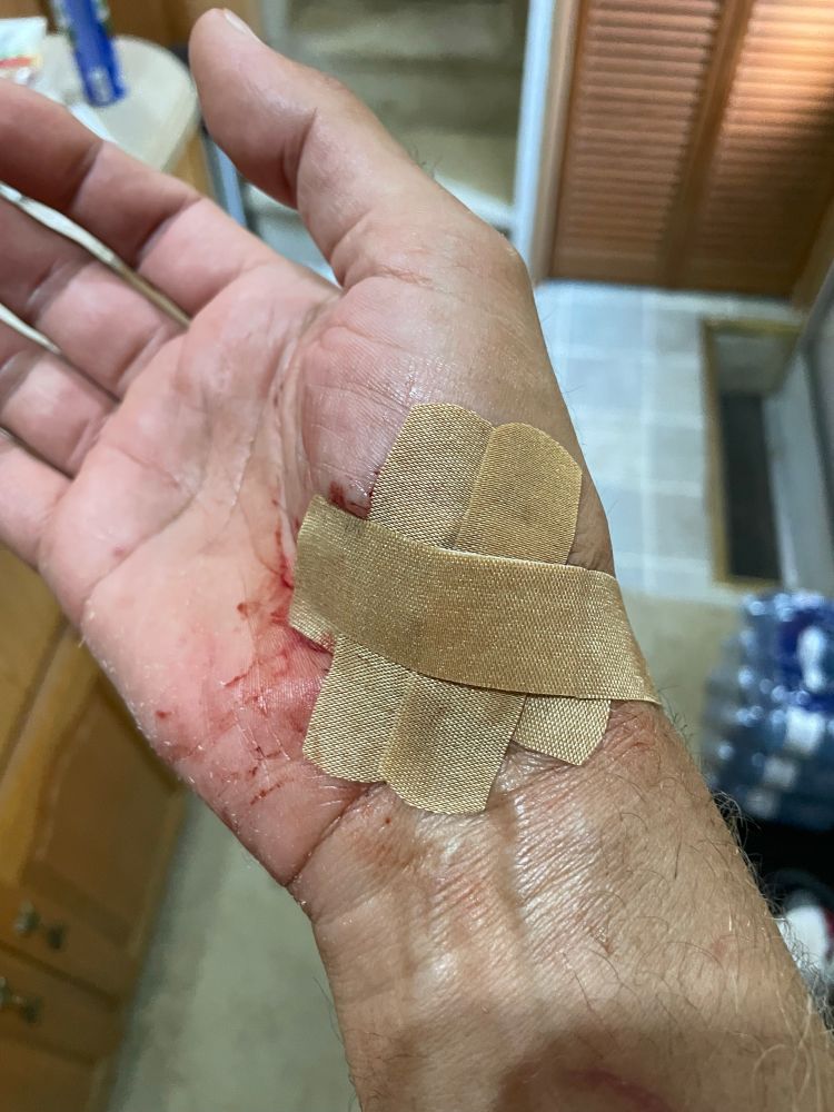 Picture of my hand with four bandages on it. Blood stains all around. 