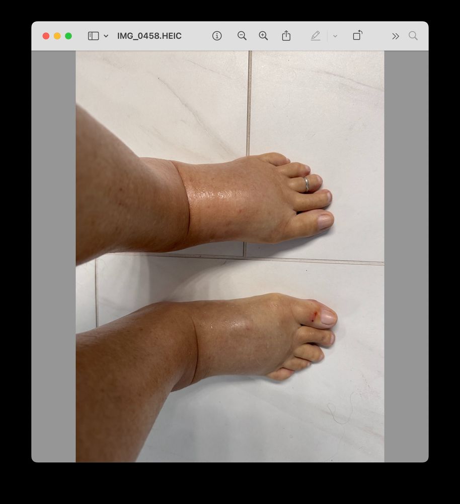 swollen feet/ankles from lymphedema