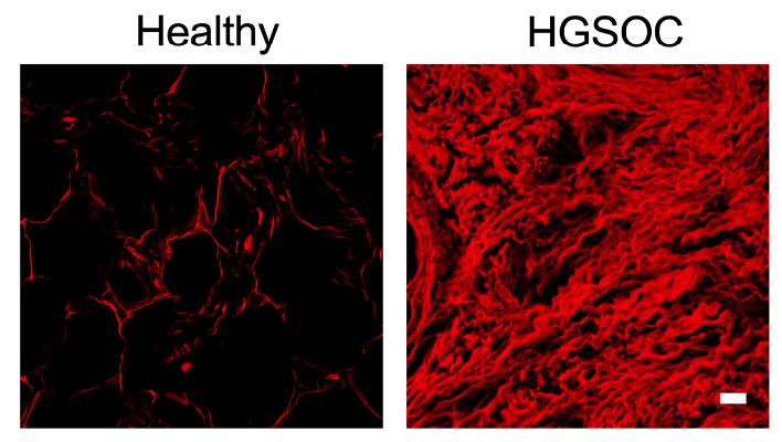 Collagen content of the human omentum and human omental HGSOC metastasis.