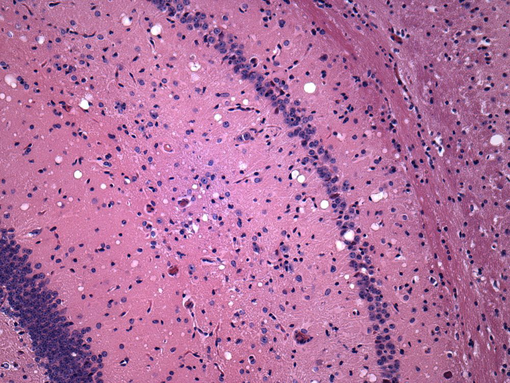 Microscopy image of a prion infected brain stained with hematoxylin and eosin to reveal the sponge-like holes (spongiosis) characteristic of prion disease