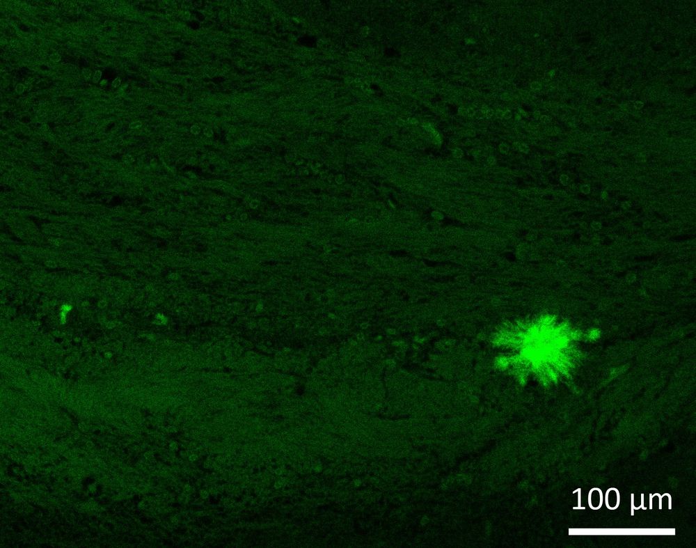 Fluorescent microscopy image of Chronic Wasting Disease prions florid (flower-like) amyloid plaque in the brain [bright green] 