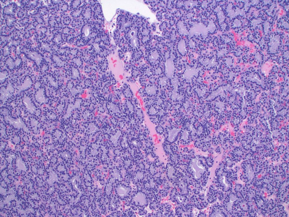 The closely packed "glands" contain dense eosinophilic material and are lined by monotonous cells.