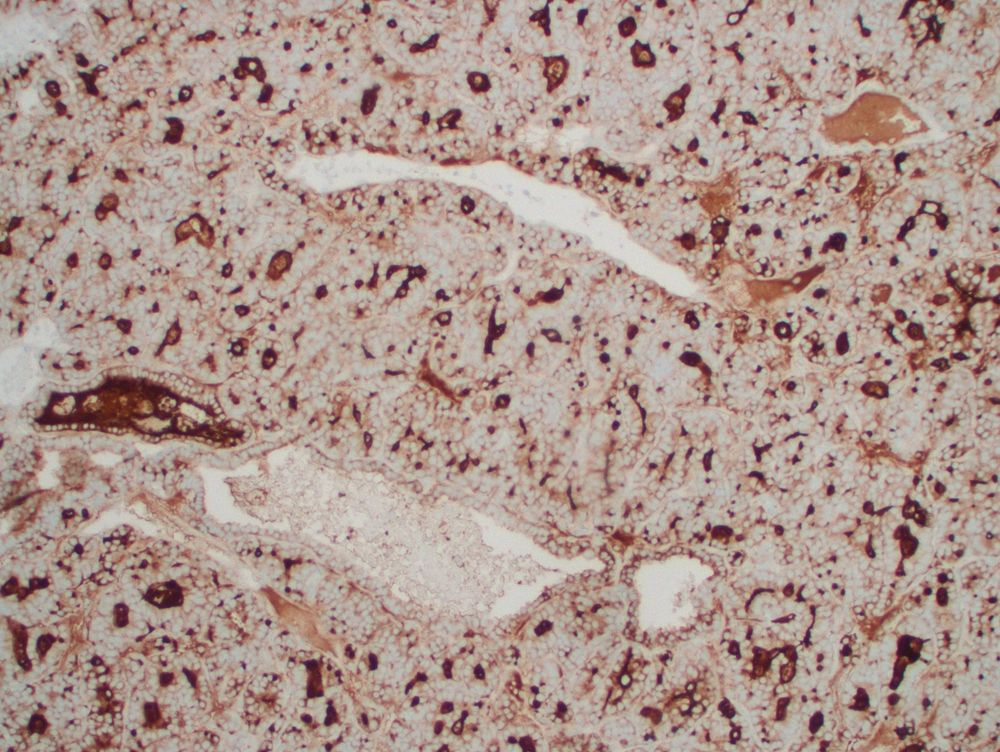 Thyroglobulin is positive.