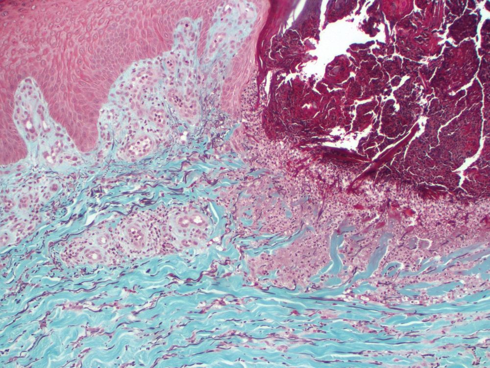Trichrome-Elastic stain: Extrusion of collagen and elastic fibers through ulcer. 