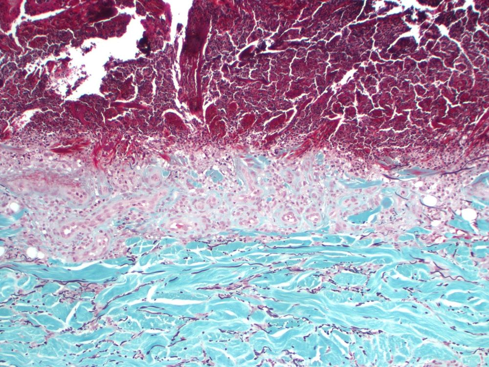Trichrome-Elastic stain shows the vertically, eosinophilic material on H&E is degenerated, swollen collagen fibers. Fragmented elastic fibers are also extruded through the ulcer.