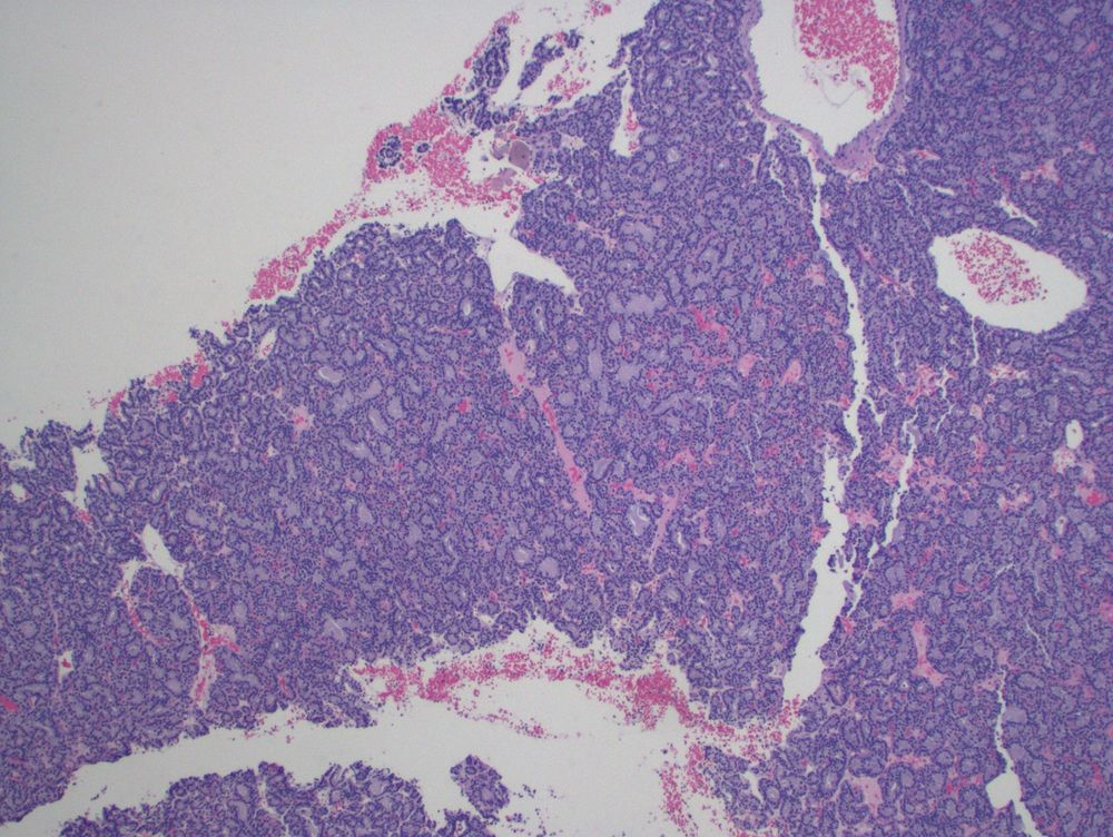Hypercellular basophilic tumor with closely packed glandular architecture.