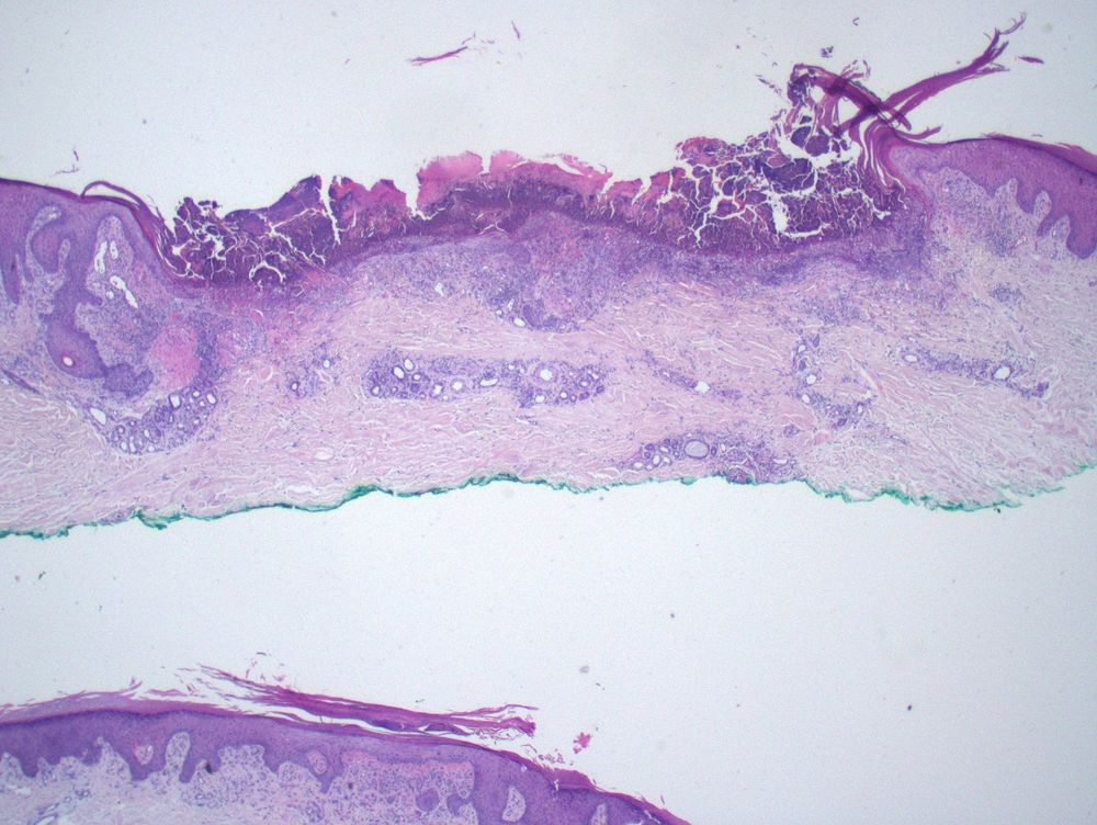 Depressed focus of ulceration covered by parakeratosis and inflammatory debris.