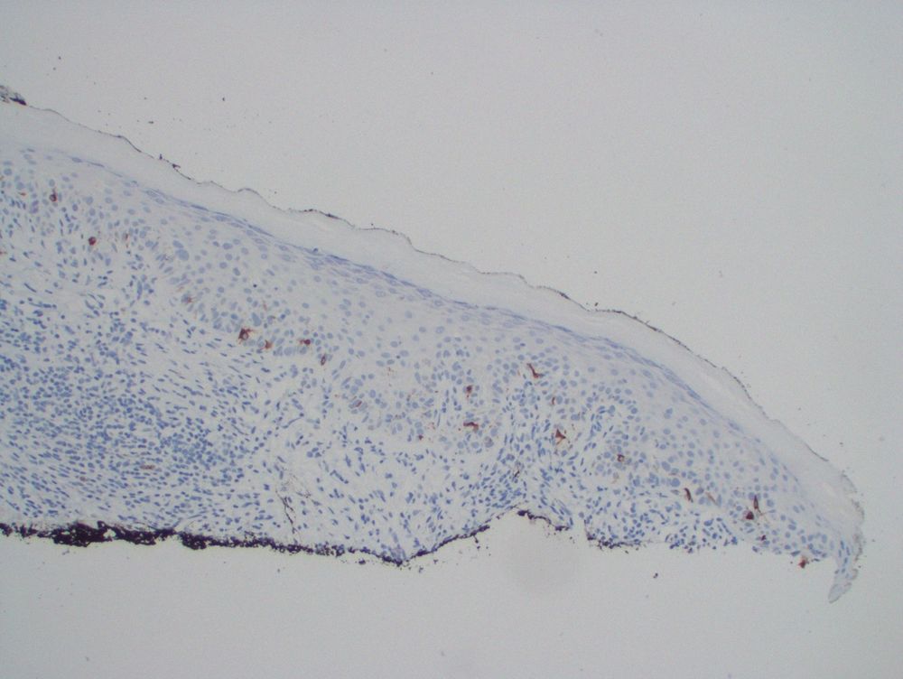 The large epithelioid cells are negative for Melan A.