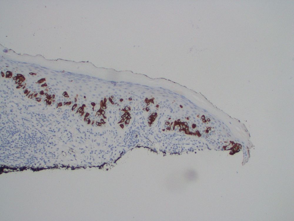 The large epithelioid cells are positive for CK7.