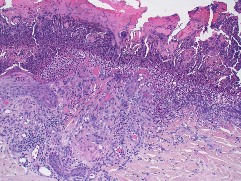 Base of ulceration shows a focally intact, thinned epidermis and vertically oriented eosinophilic material disrupting the epidermis.