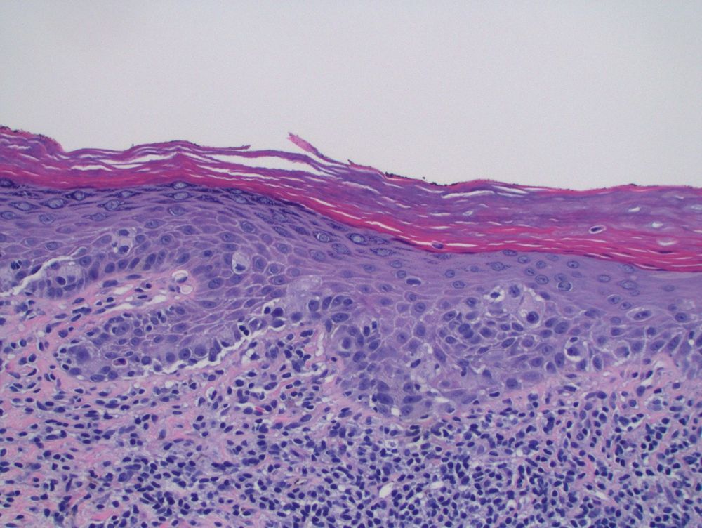 The basal layer and mid dermis contain large epithelioid cells with ample, delicate cytoplasm scattered in the epidermis as single cells.