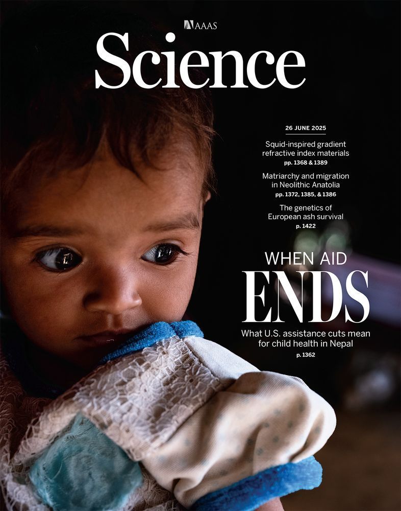 Radha Maurya, a 10-month-old living in the village of Nausahara, Nepal, is being treated for severe wasting.
