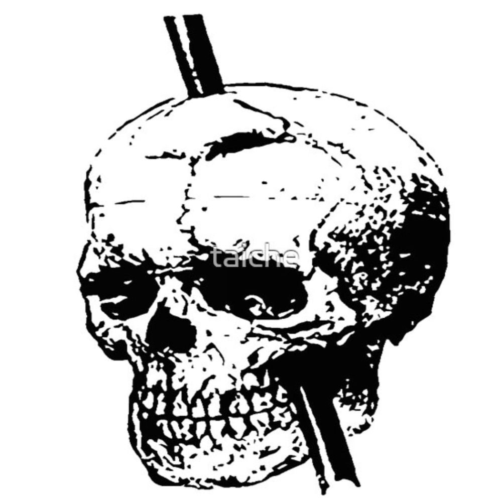 Skull With Tamping Iron Diagram Front And Lateral View  by taiche | Redbubble